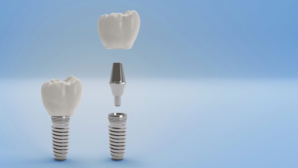 Dental Implants in Carrollton, TX