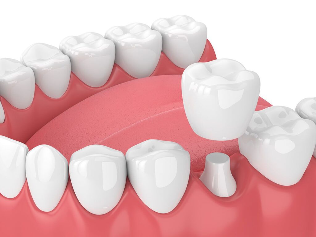 Do I Need a Dental Crown to Treat Tooth Sensitivity
