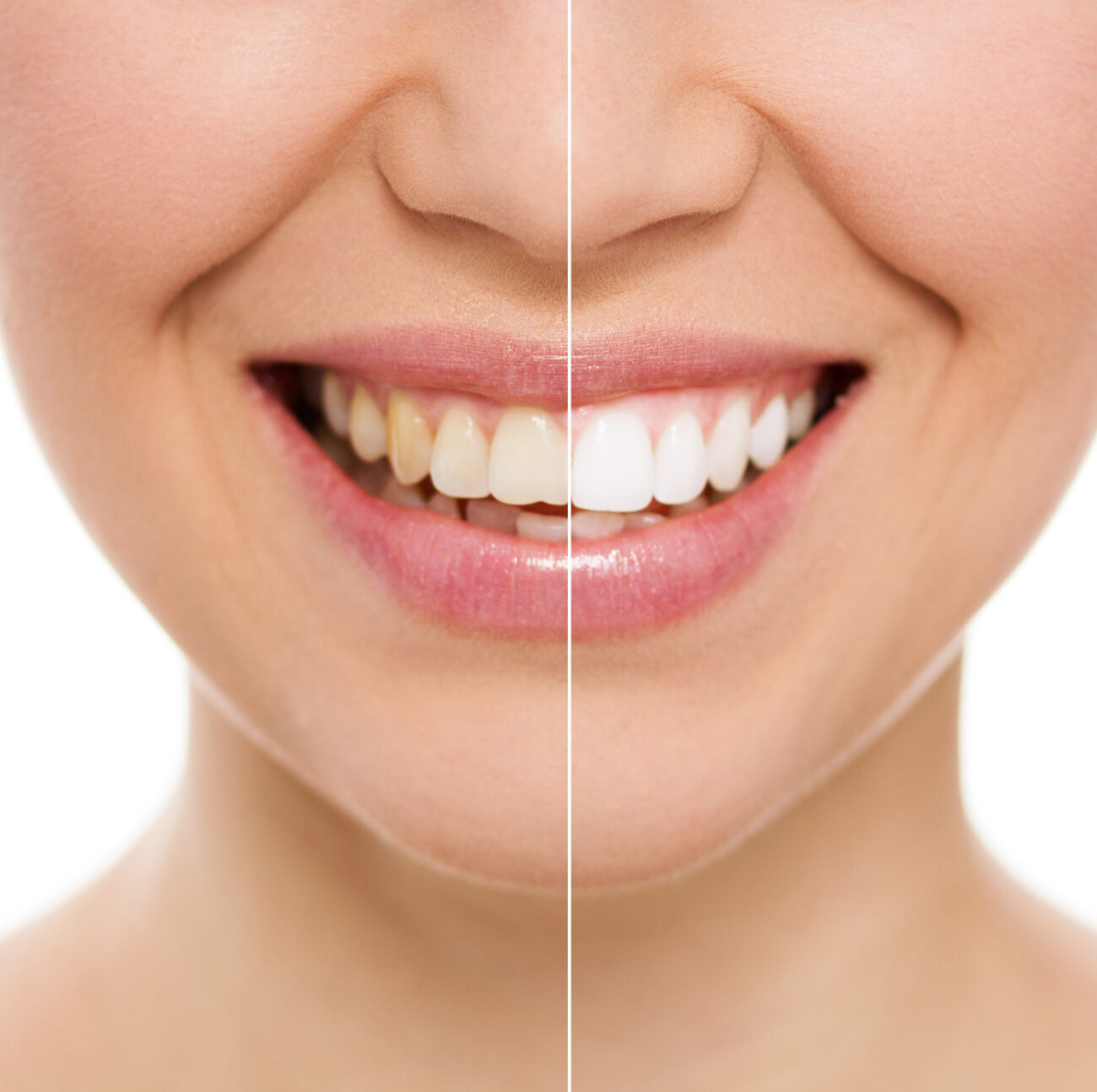 Teeth Whitening in Carrollton TX